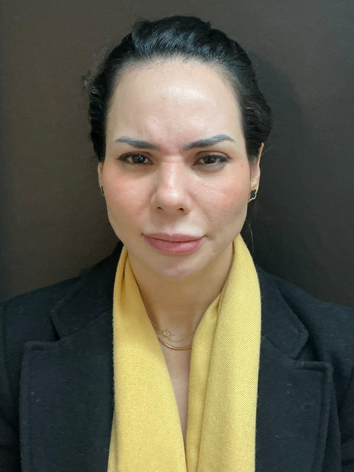 Rosto feminino com testa lisa e expressão suavizada antes da harmonização facial